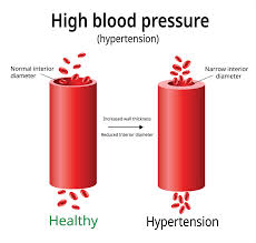 High blood pressure cure